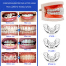 Acessório alinhador de dentes(Aparelho ortodôntico,tenha o sorriso dos sonhos)