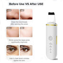 Purificador de pele ultra-sônico para limpeza facial removedor de cravos e impurezas (Um novo ciclo para a sua pele)